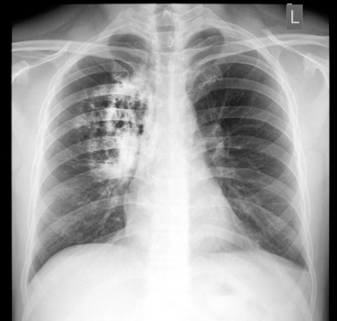 COVID-19 Lung Damage